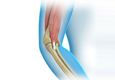 Elbow Tendon and Ligament Repair