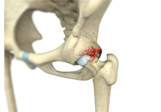 Hip FAO Surgery