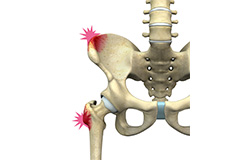 Hip Pointers