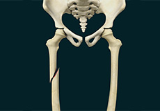 Pediatric Thighbone (Femur) Fracture